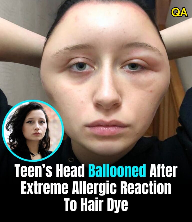 “My head swelling got so bad I could barely breathe”