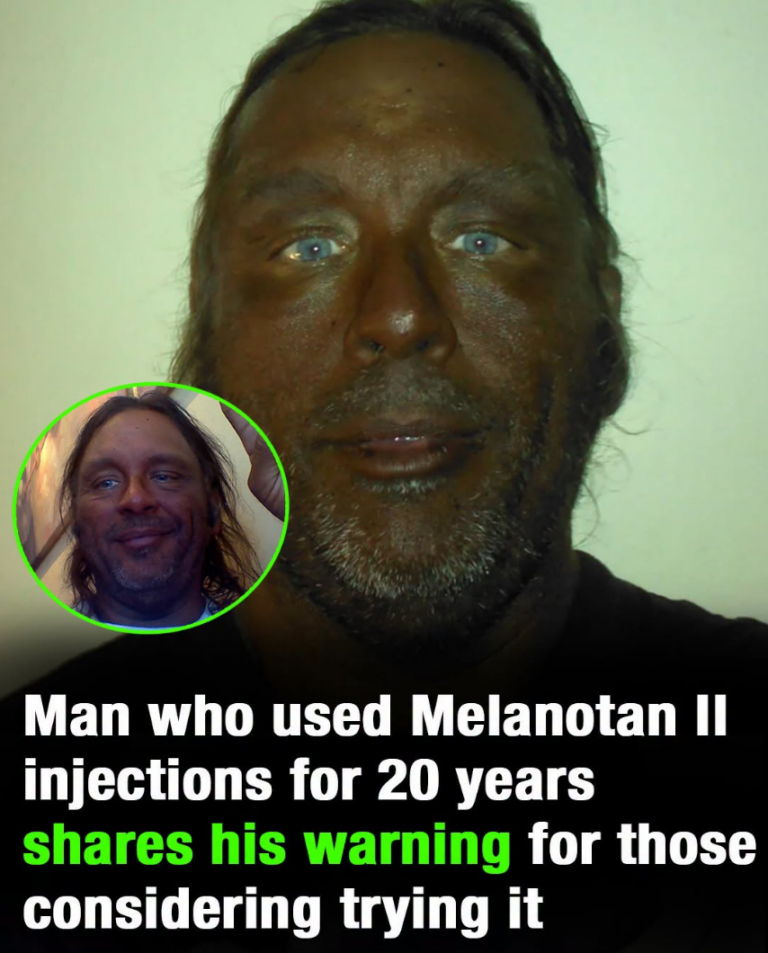 He started taking Melanotan II injections 17 years ago… and now he’s sharing his warning